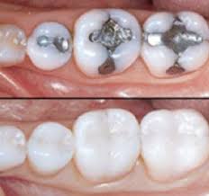 Silver or White Filling?